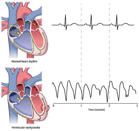 Tachycardia .